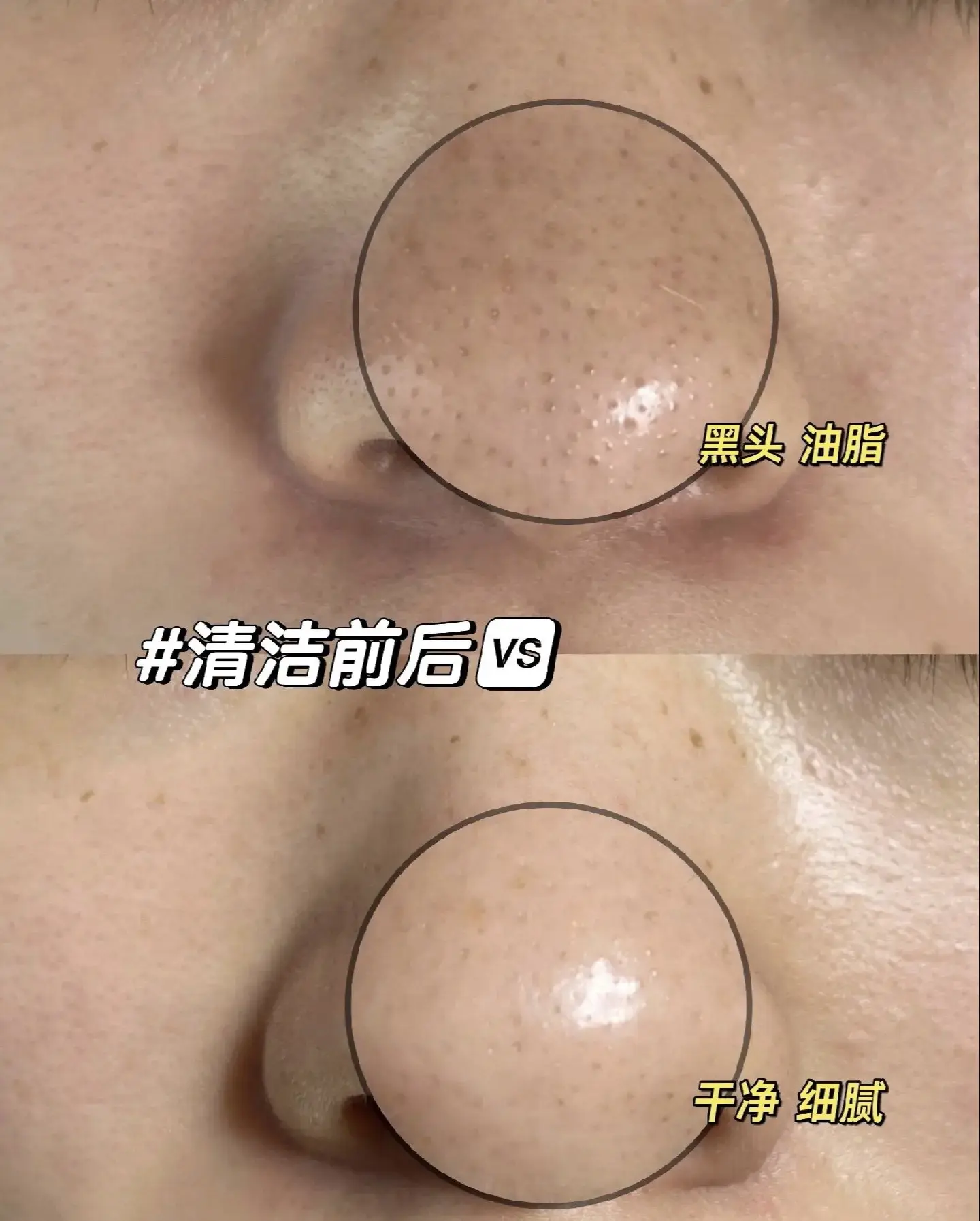 我们终于也上团购了，快来体验一下吧。男女不限，小气泡去黑头加补水。