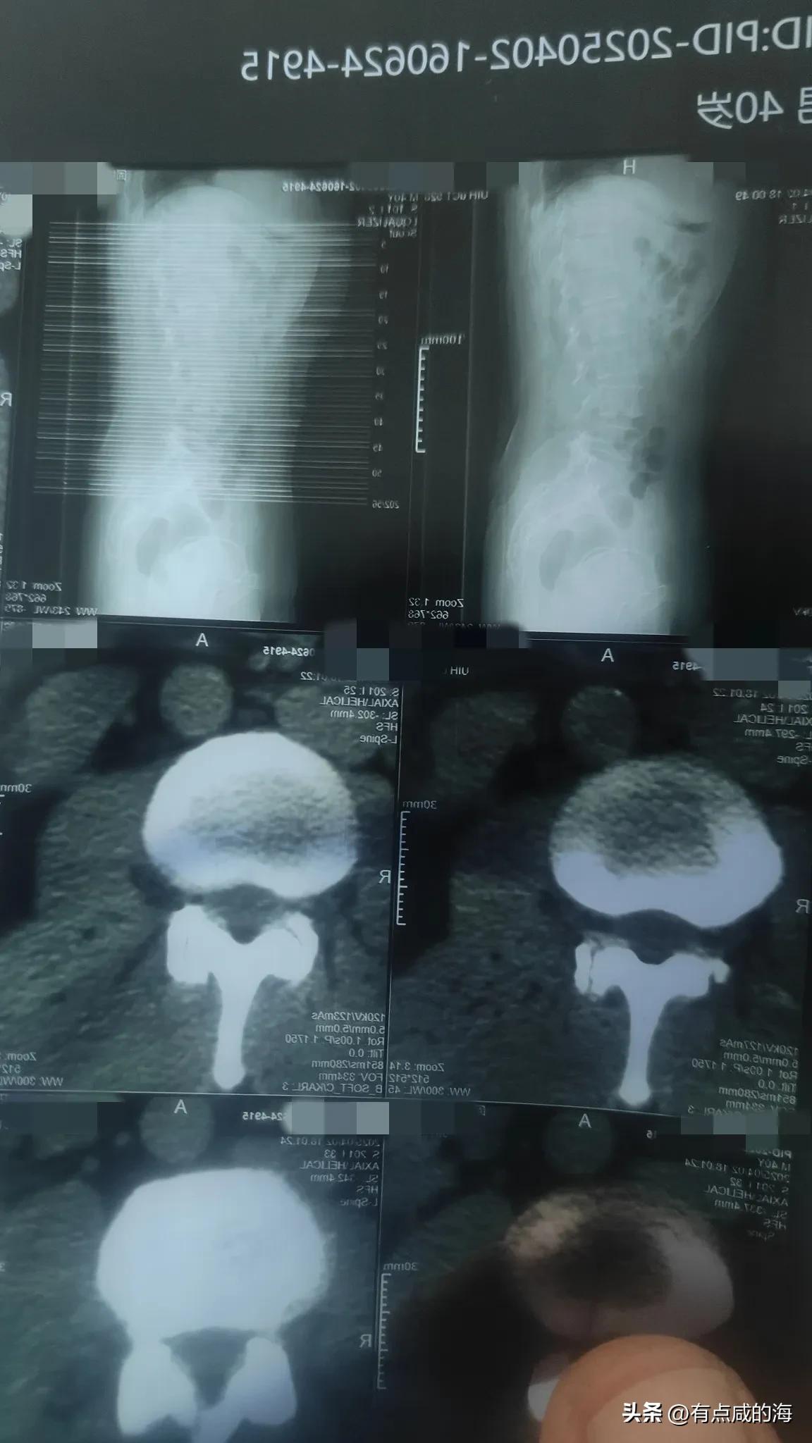 哪位大哥大姐给看看片子，刚拍的 说有点腰间盘突出，还说有个肾结石，花生米大小，现