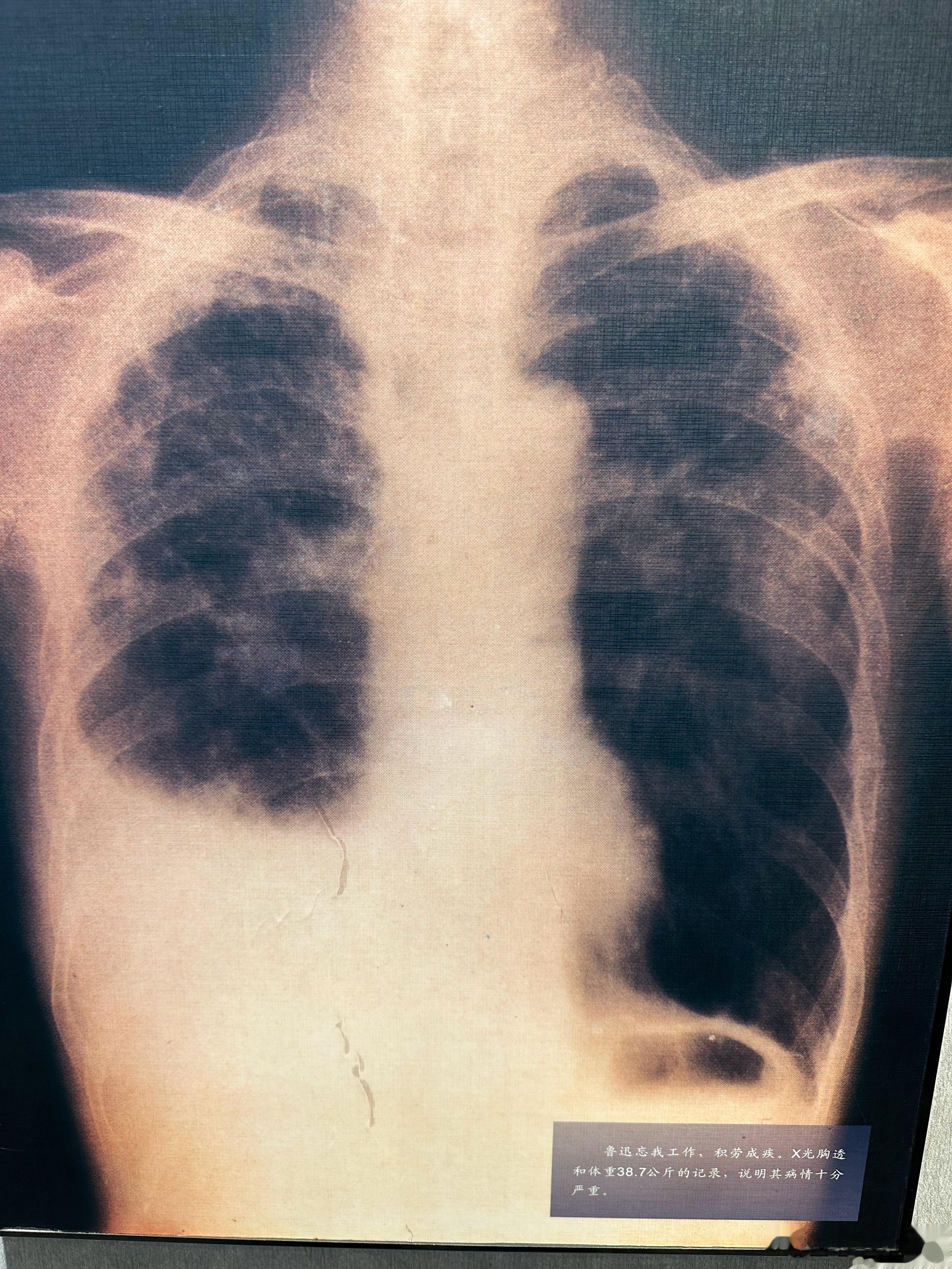 在鲁迅纪念馆，看到了鲁迅先生生前的胸片。一开始，我很奇怪，先生的纵隔和心脏怎么会