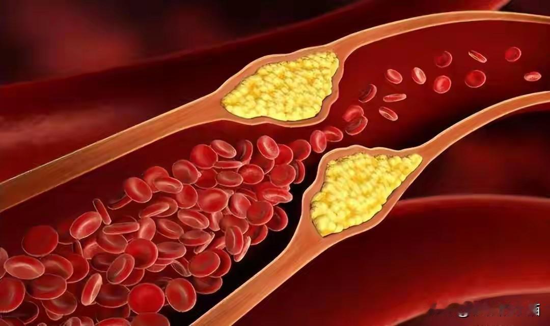 一针管半年的降脂好药进医保了！
 
英克司兰纳入医保，是高血脂患者的福音。一年两