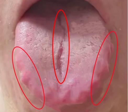 门诊遇见最多的就是裂纹舌，虽然这个有很重的齿痕，但要真的去健脾祛湿，不仅没效果，