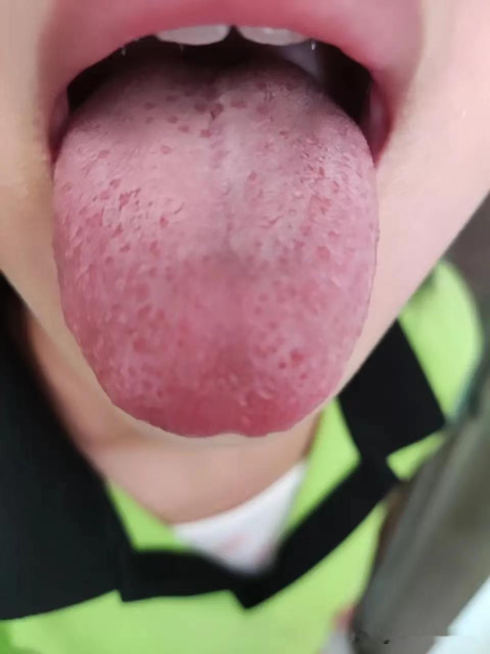舌苔白腻的孩子，要注意了！

前两天我接诊了一个10岁3个月的女孩，我一看孩子面