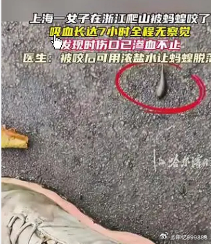 女子山间徒步遭蚂蝗吸血全程无感,伤口处仍可见一圈紫红色的血迹，中心有一块黑色的痂