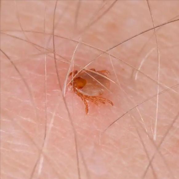 男子腹部痒，医生用镊子夹出16只阴虱！原来阴虱有2个传播途径

阴虱是一种寄生在
