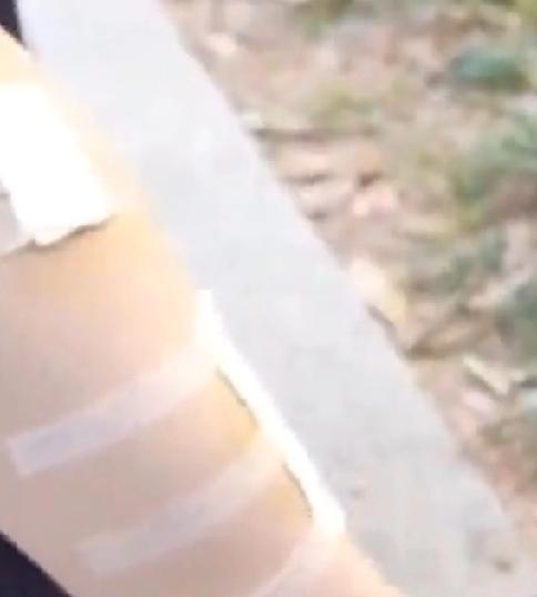 破璃门爆裂无先兆
女顾客美容需要全裸，护理时突然玻璃门爆裂伤到全身，其腰、臀、脚