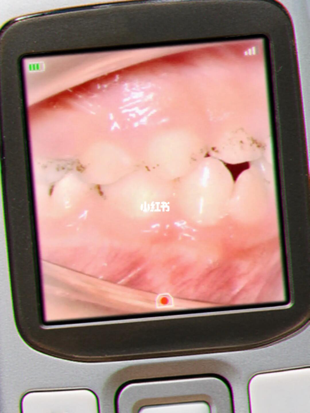 牙齿上黑色得斑斑点点是龋齿吗？