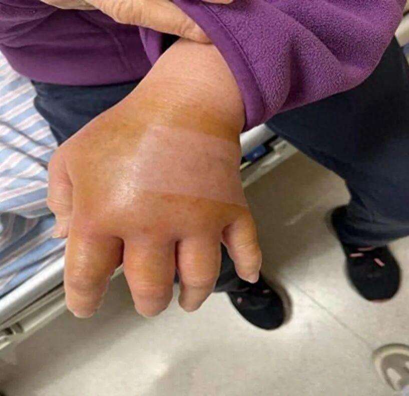 警钟敲响！五一家家都在做海鲜大餐，上海七旬阿婆只因处理鱼虾被小小鱼刺扎伤手指，简