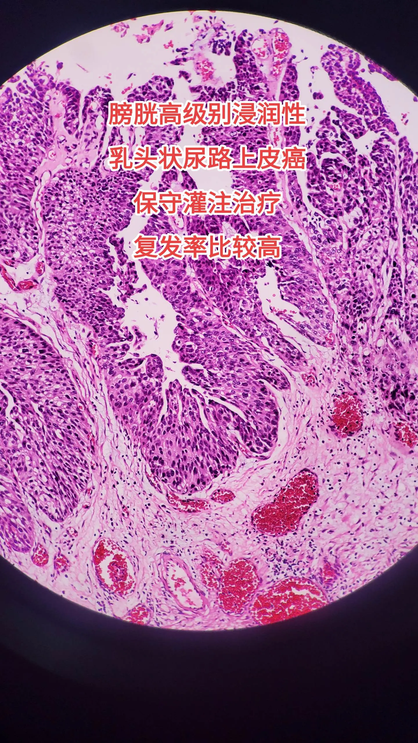 膀胱癌