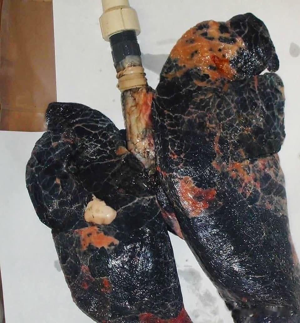 重度吸烟者的肺
上面的照片显示了用肉眼检查终生吸烟者的肺部的样子。当您吸入香烟烟