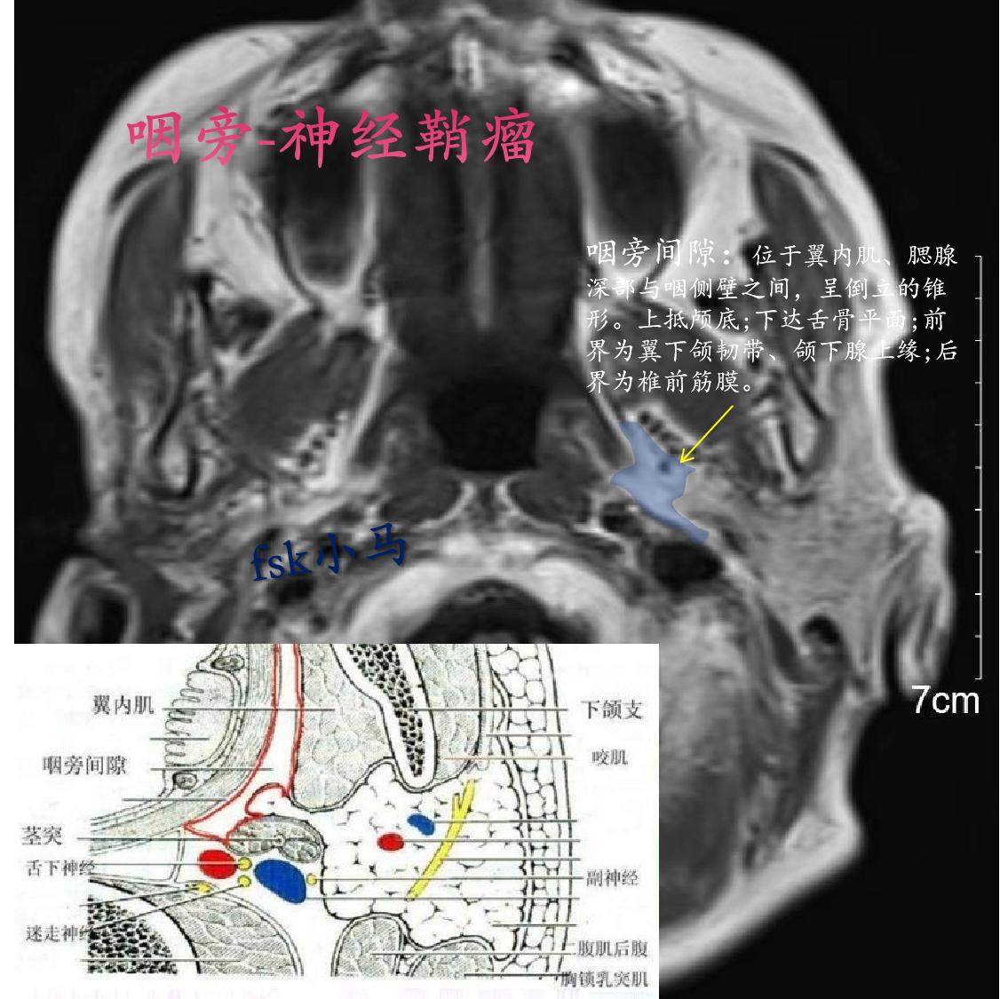 神经鞘瘤源于神经髓鞘Schwan细胞，是周围神经中最常见的一种良性肿瘤...