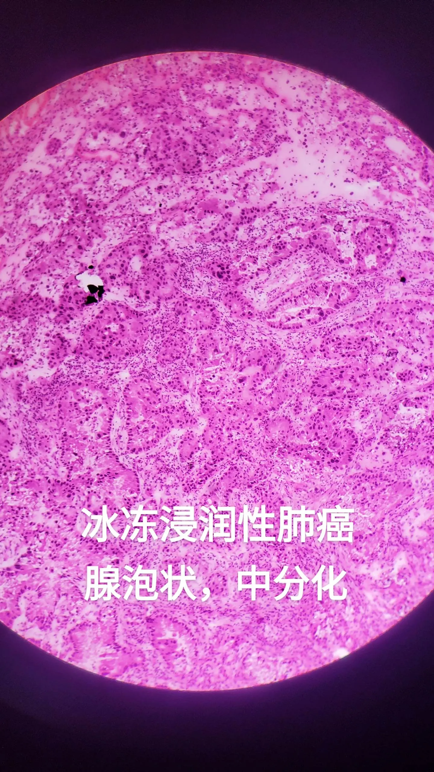 肺腺癌