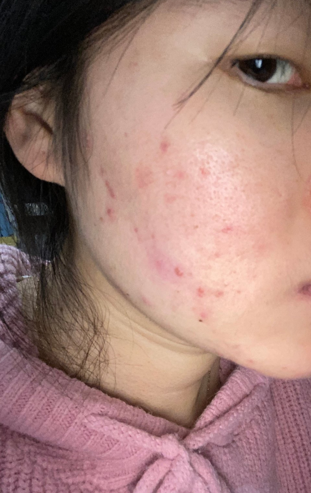 皮肤问题到底让人有多崩溃 我的真实皮肤修护经历：告别反复长痘泛红前两年我的皮肤状