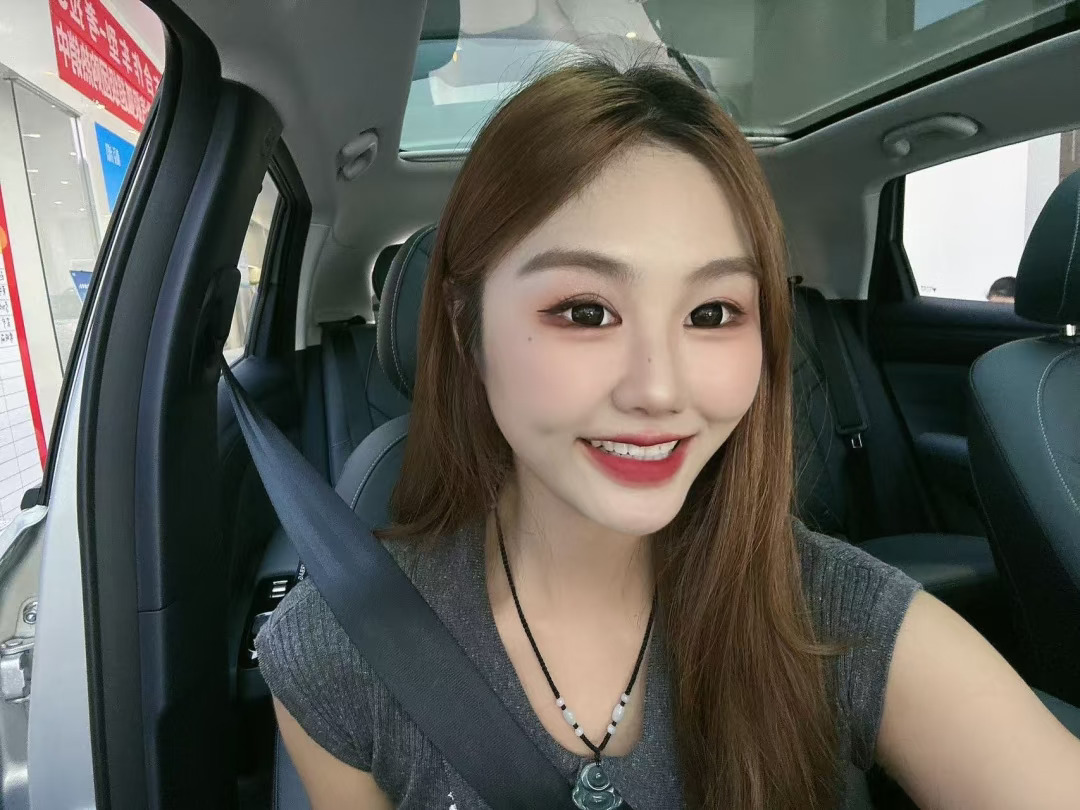 深覆合下巴后缩郑州正畸，保留了我的翘人中