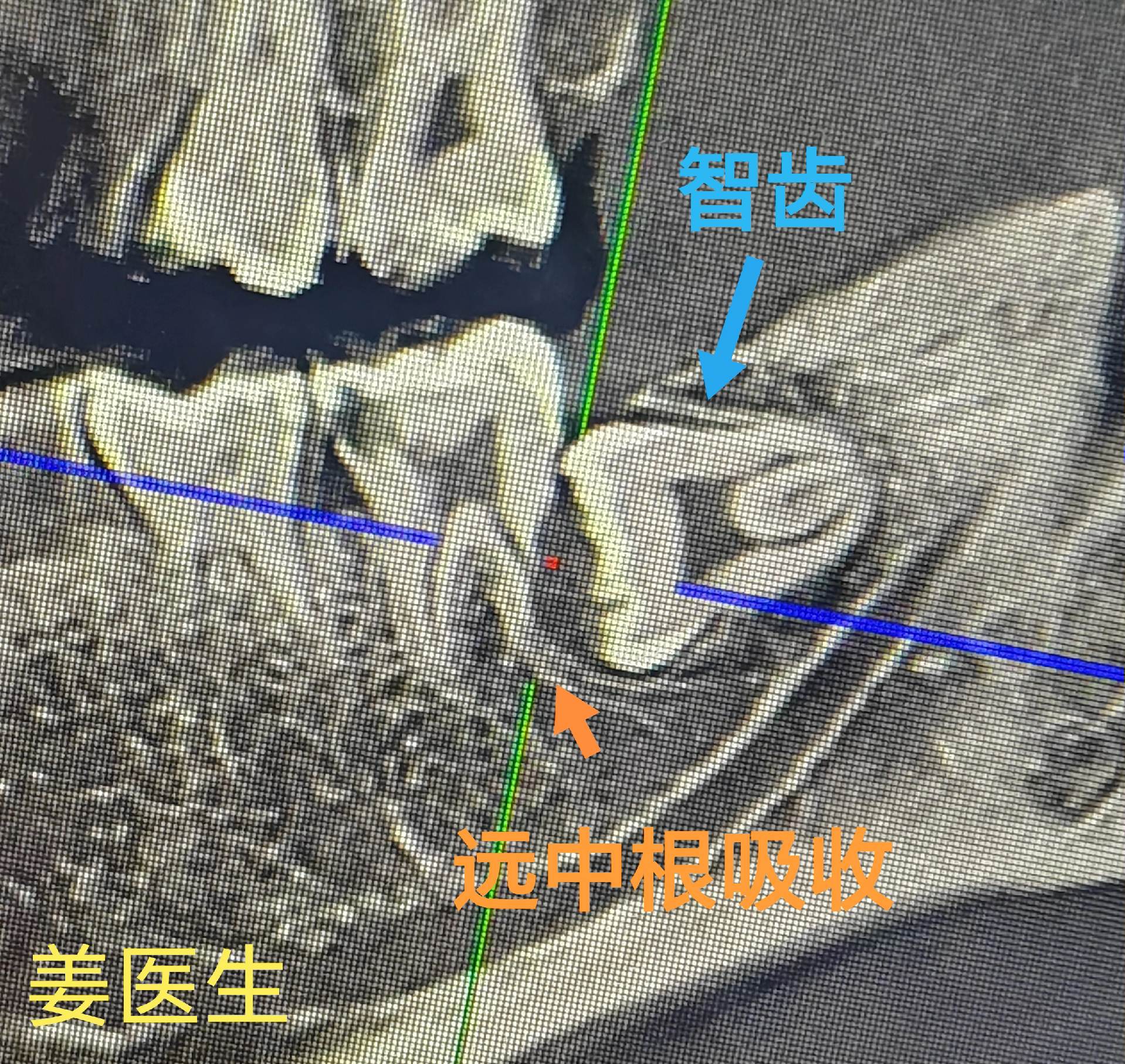 埋伏智齿 导致相邻磨牙牙根吸收，将智齿及邻牙一起拔除，同期植入植体。