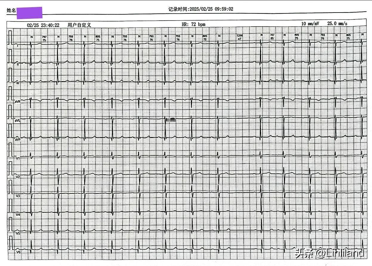 这是1例“胸闷、憋气”患者的两幅动态心电图截图。一幅截图于晚23时40分，另一幅