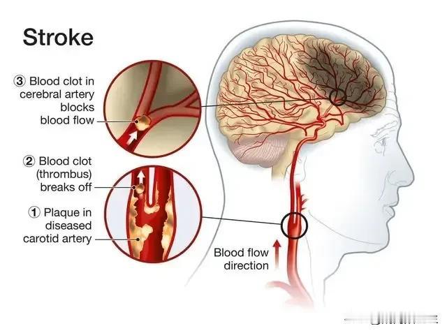 #哪些人容易患有颈动脉斑块?#
年龄大约40周岁的人群，
伴有糖尿病，高血压，血
