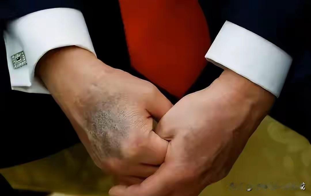 特朗普的手紫青，而且貌似越来越严重的感觉！而且也因此造成了腿脚的浮肿，引发了舆论