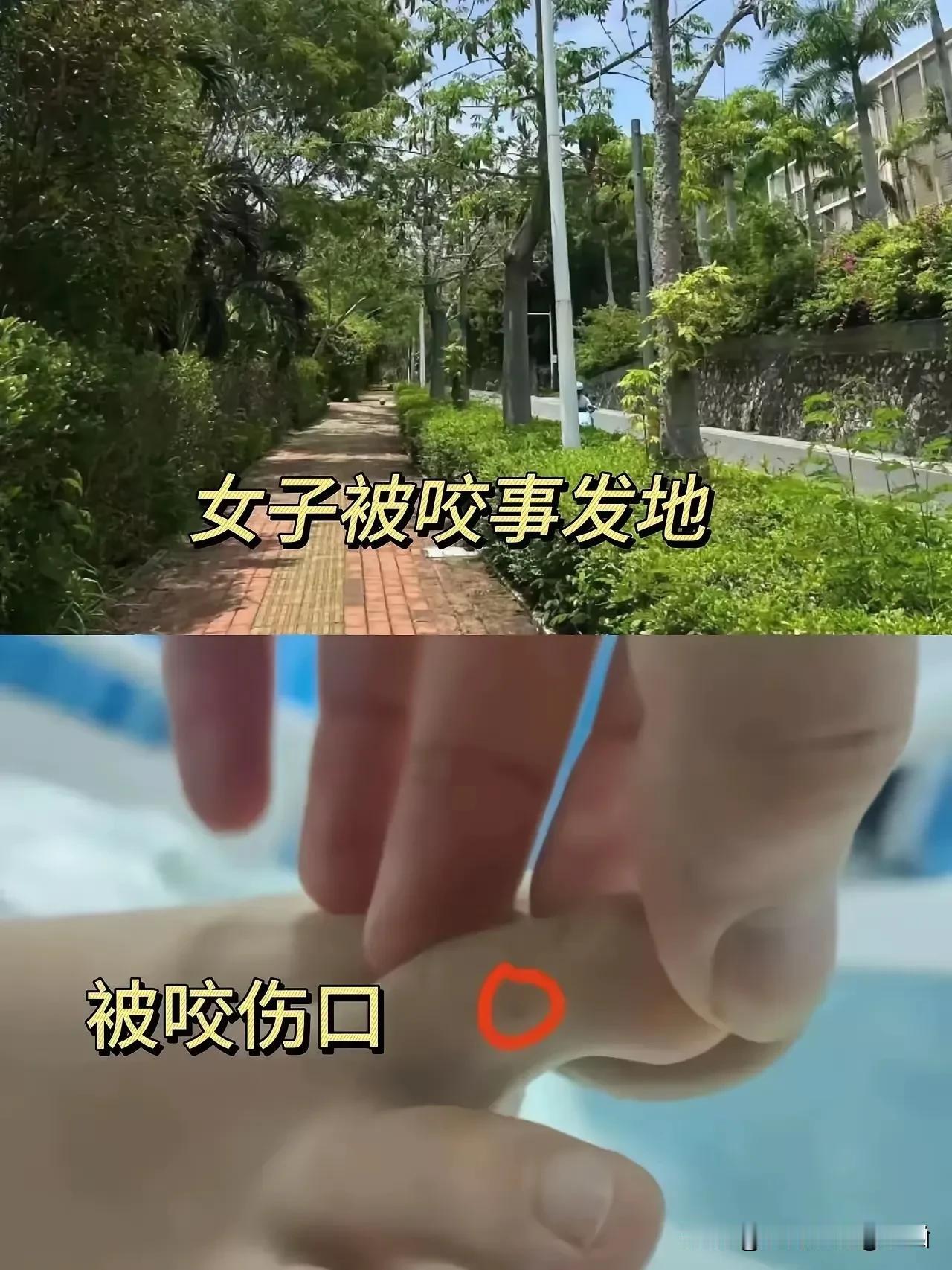 三亚旅游被蛇咬死的女孩伤口曝光，就这么一个不起眼的小伤口，就要了这个26岁妙龄女