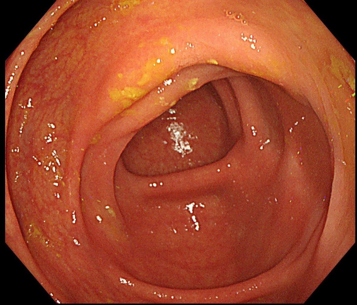 结肠SSL 醋酸染色。染色效果不亚于靛胭脂，结合NBI，Near fo...