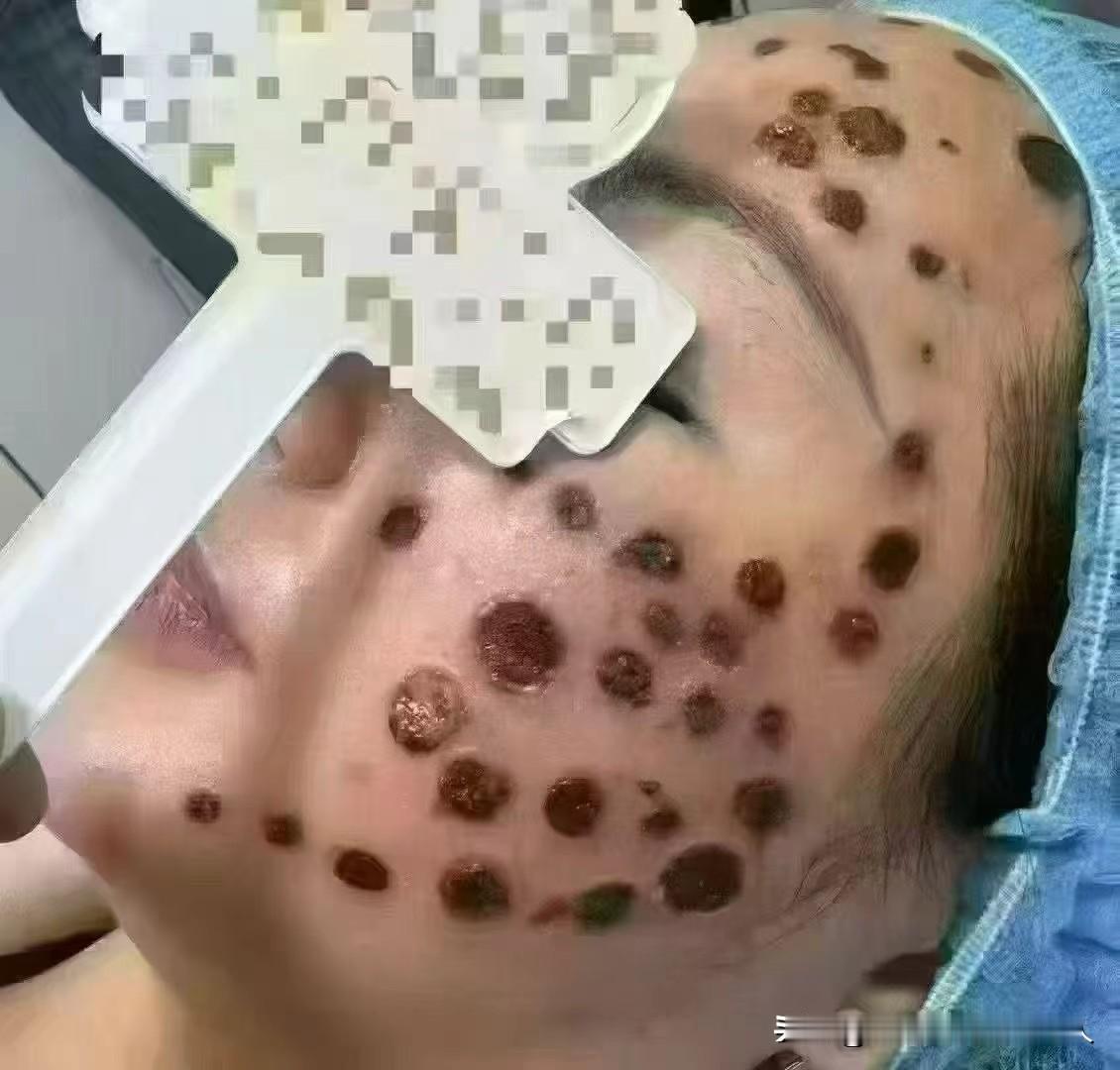 某民间中医大神，帮别人做的美容针灸。
现在脸全毁了。
针灸为什么无法兴盛起来呢?