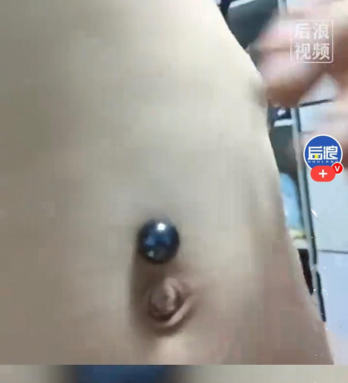 近日，云南昆明一名小男孩玩耍时，不慎将磁铁珠吞进肚子里。情急之下，孩子妈妈找来另