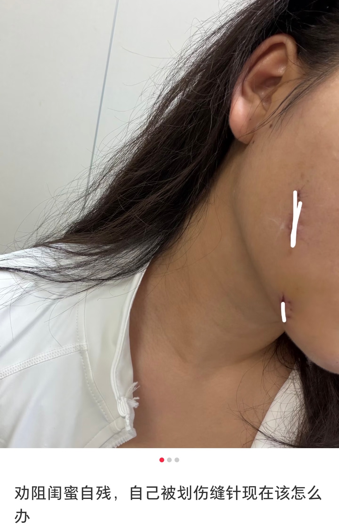 天呐，这个贴主阻止闺蜜自can导致自己被划伤，现在跟这个闺蜜因为医药费闹掰了……