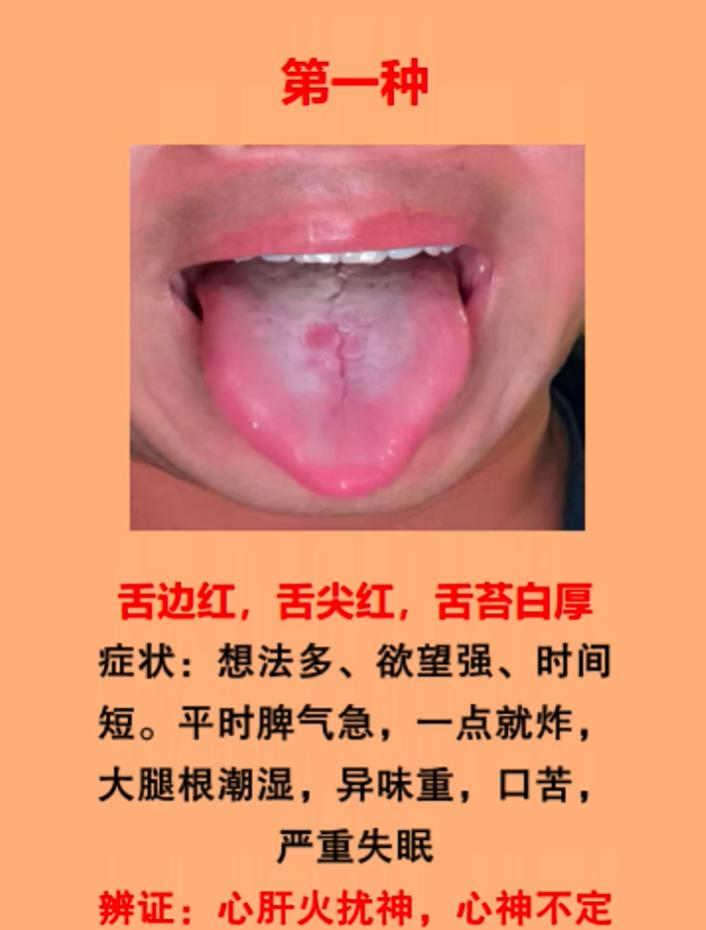 观舌辨证：肝郁、痰湿、阳虚引发身体困扰如何区分