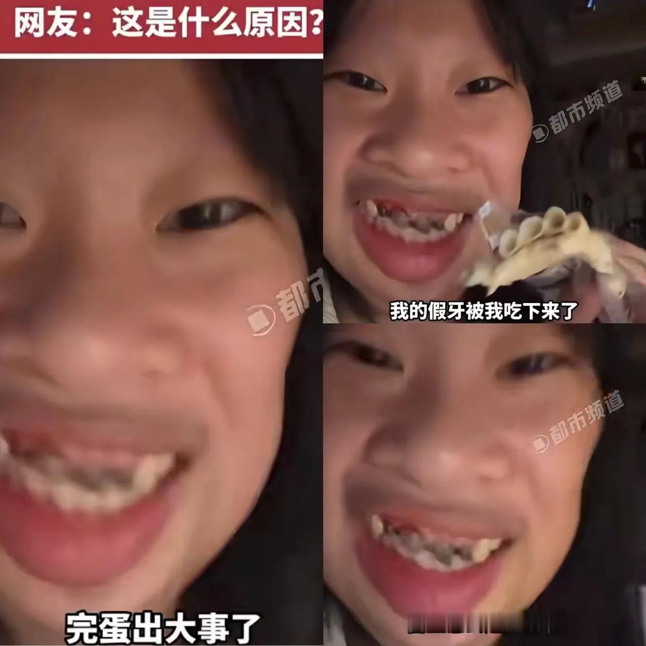 一觉醒来
戴牙冠的朋友看完估计要慌了！

福建那21岁女生，吃个东西居然把四颗牙