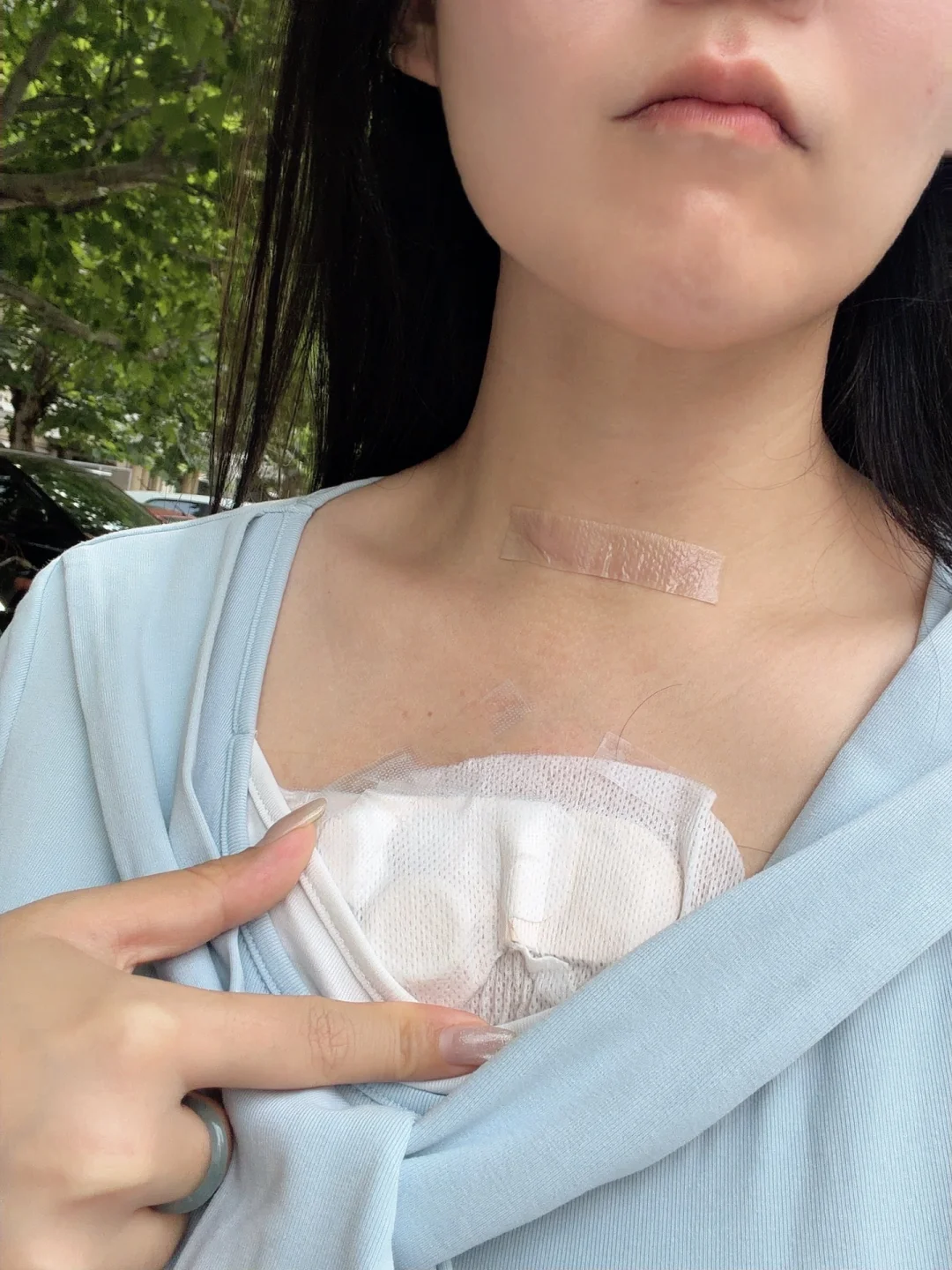 这个胶布过敏了能摘了不？