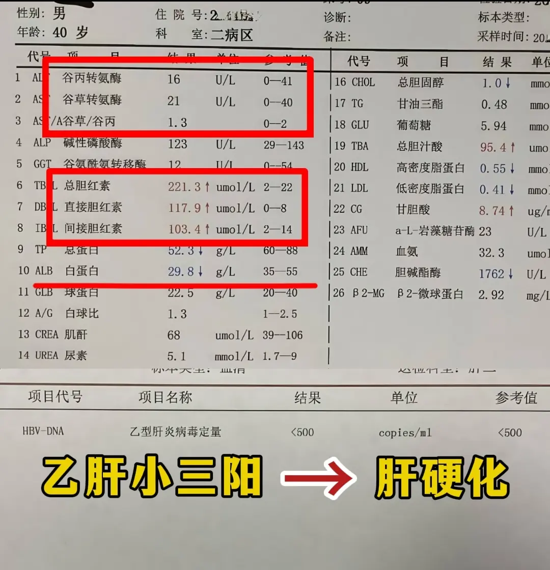 大家看这位山东潍坊患者的检查单，转氨酶正常，胆红素却高的厉害221，白...