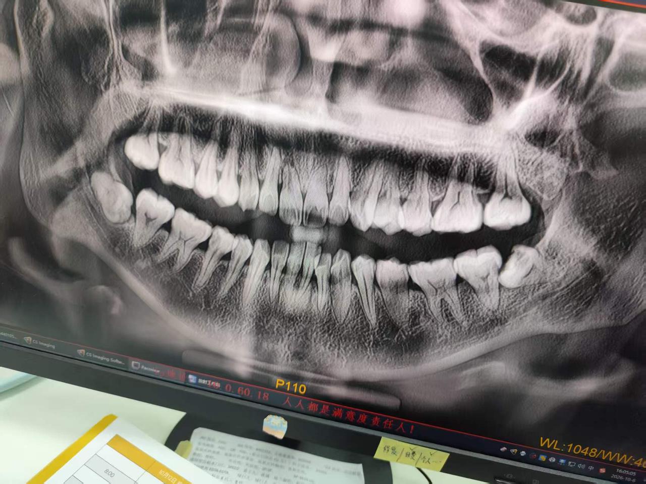 被这两科智齿折磨好几个月了，卡东西，蛀牙，右边的都感觉很臭，下定决心现在打算拔掉