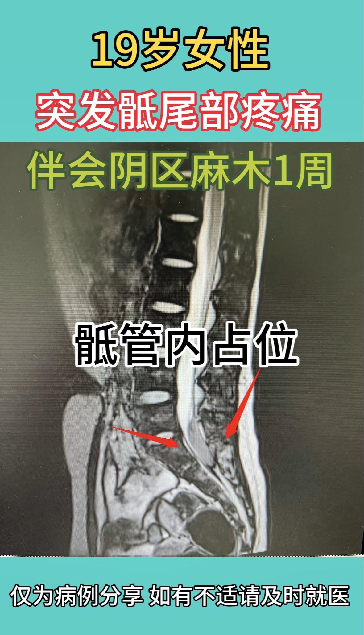 60岁男性，左上肢麻木伴下肢无力2年余，术前磁共振提示颈5/6受压重...