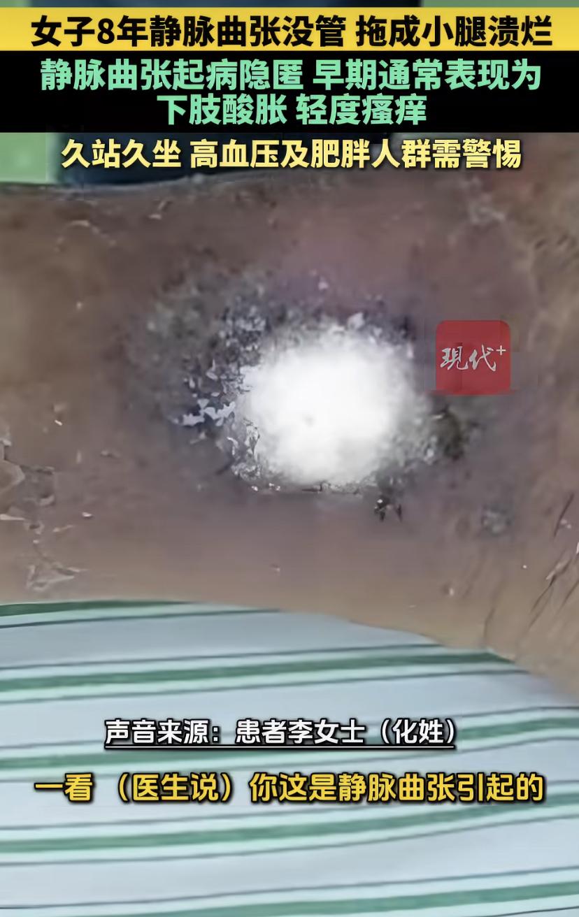 腿上青筋拖了8年，最后烂出个洞!医生:本可以避免
南京的李阿姨今年六十出头，腿上