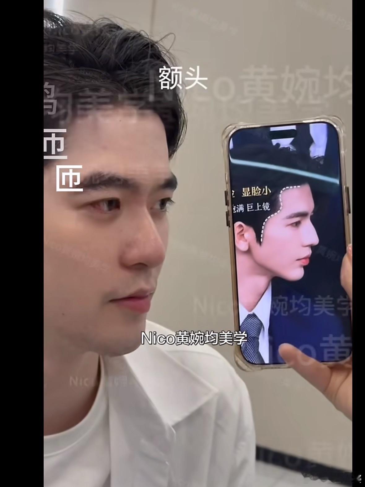 赵樱子弟弟整成张凌赫了 客观说一句，张凌赫那个骨相是真的顶配，不是单靠额结节和鼻