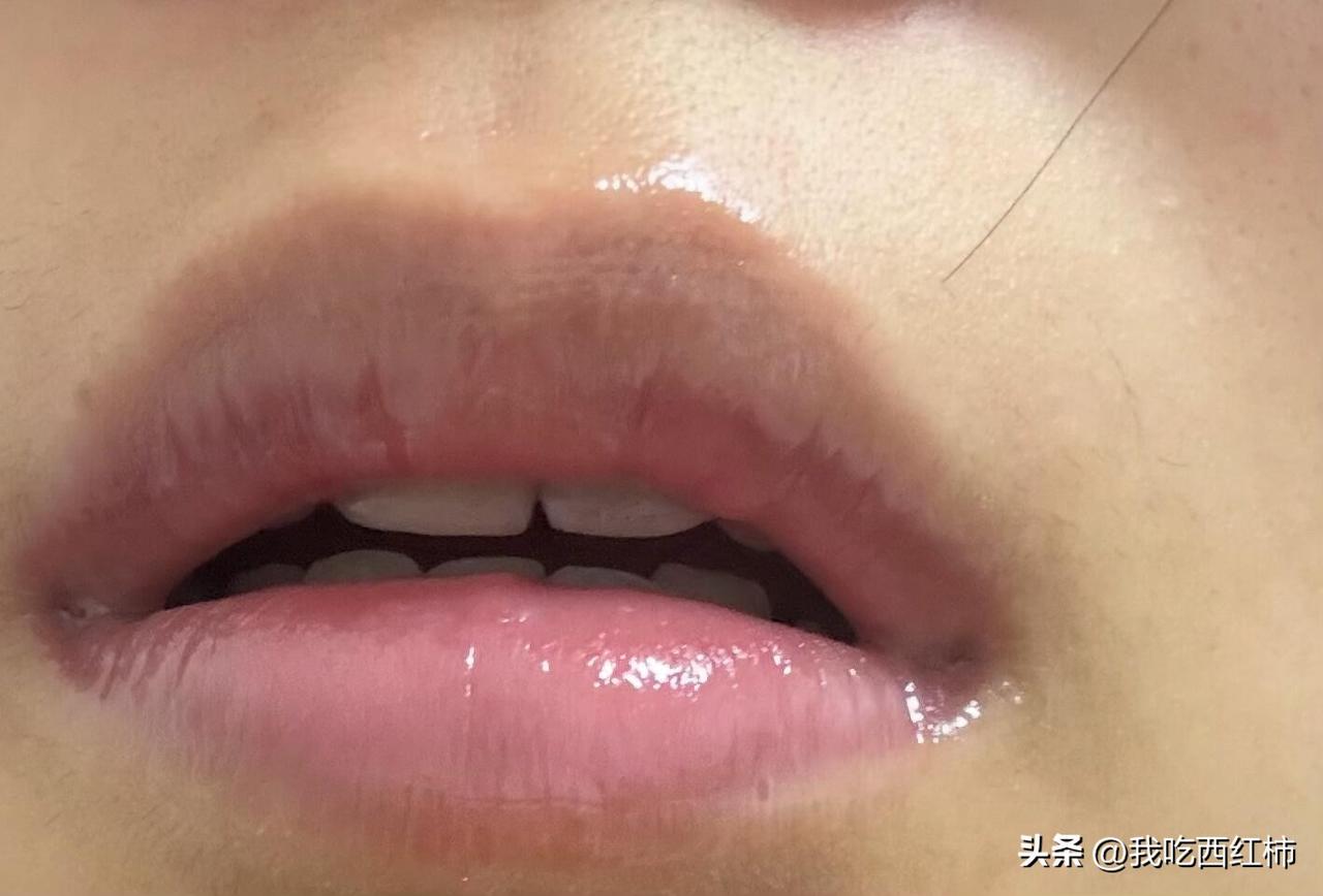 烧到39度，去蒙古医院医生说我不发烧🤡
发烧烧了两天半，嘴唇子都给我烧破了，我