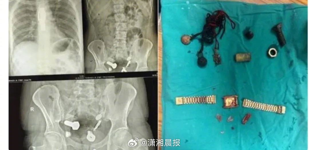 【#印度男子腹痛体内有手表铁片大理石#，#印度男子因幻觉吞异物#】印度拉贾斯坦州