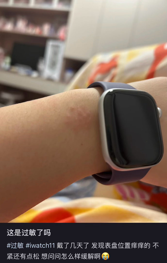 运动手环 皮炎我记得之前还看到过有人带 Apple watch 过敏，不是表带，