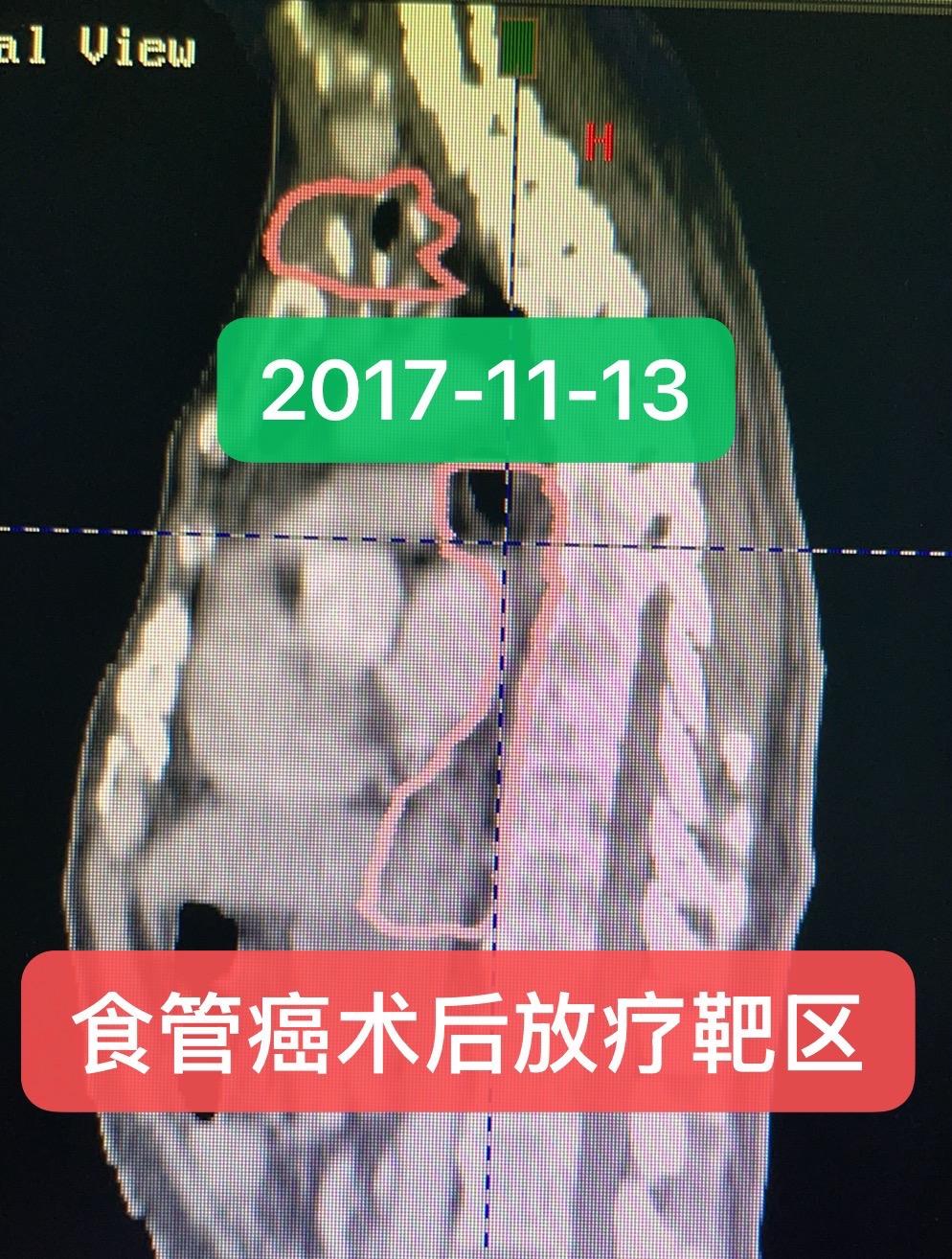 食管癌术后放化疗后9年：治愈。男，49岁，2017年7月因进食梗阻，当...