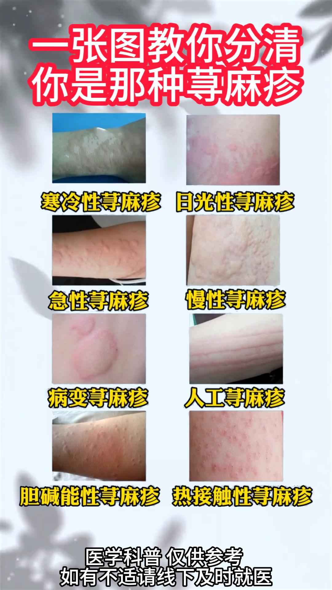 一张图教你分清 你是哪种荨麻疹#中医##健康#
