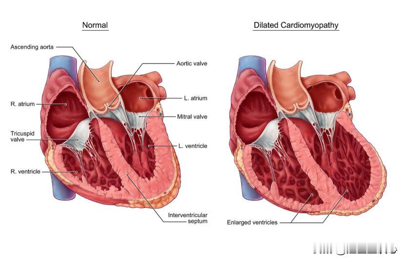 心脏变大了，为什么还会动力不足？我们的心脏就像一座房子，拥有四个房间：左右心房和