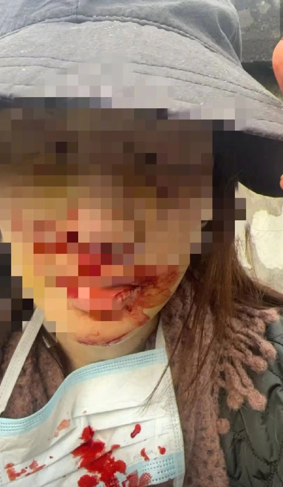 金晨公开道歉，看着受伤挺严重的！按她的说法，是她助理擅自替她担了责任，万万没有想