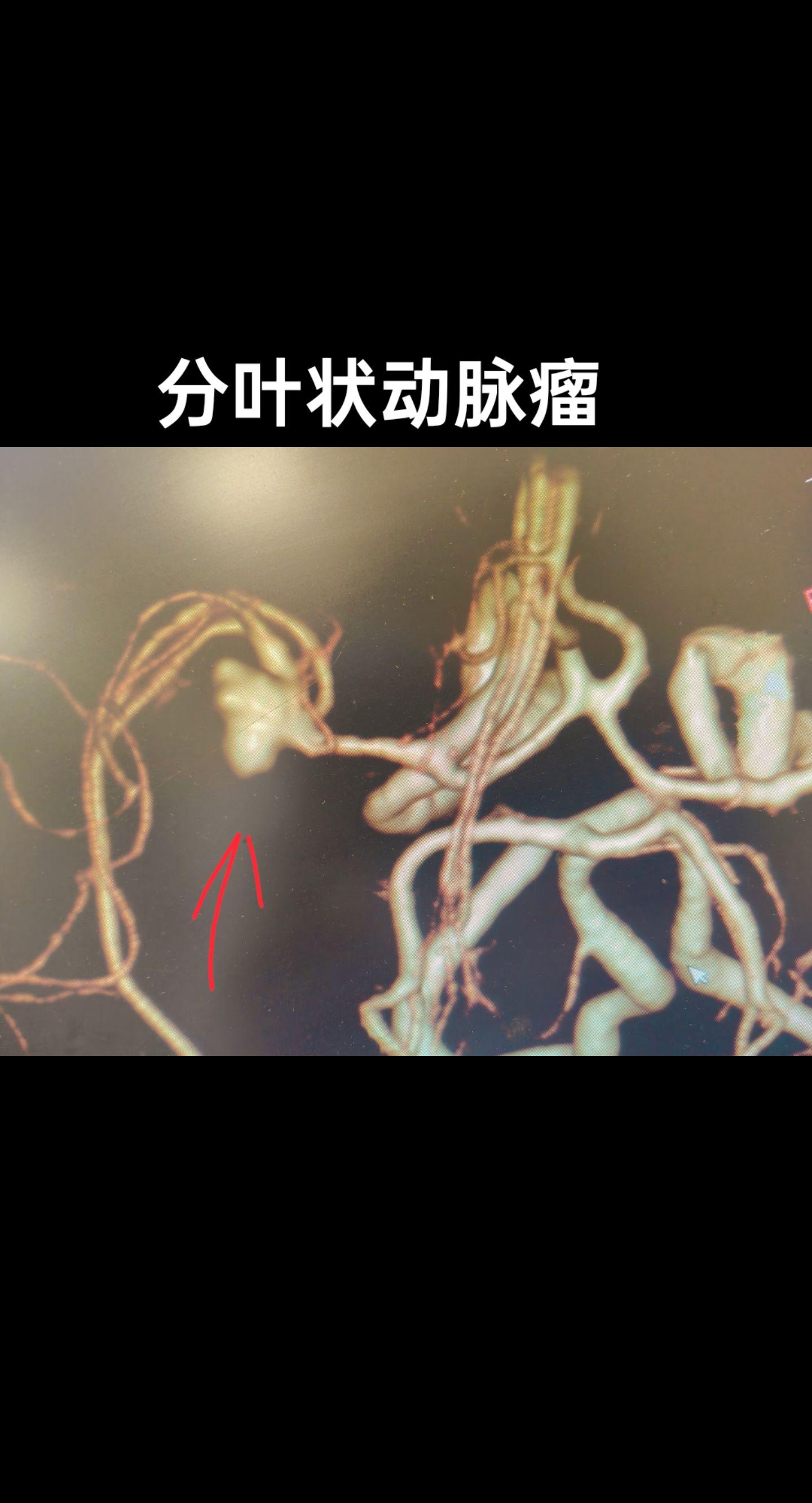 盘点那些容易破裂出血的脑动脉瘤