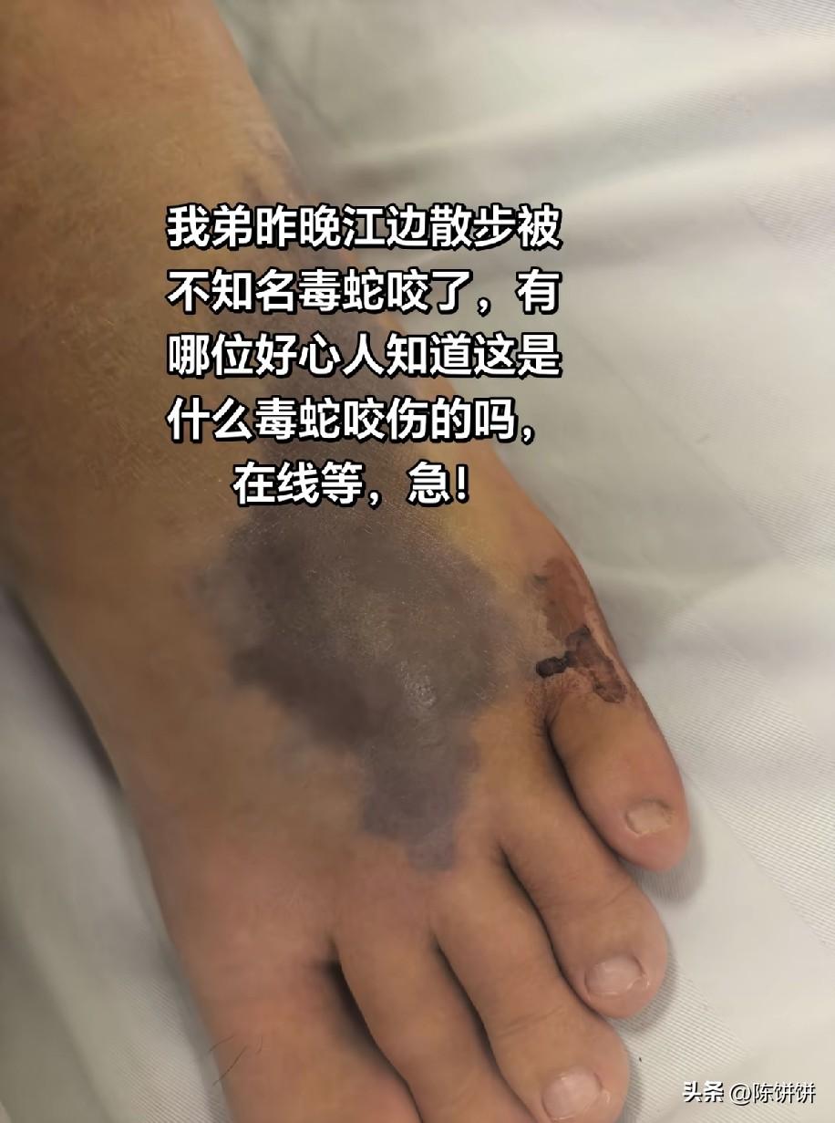 在线紧急求助！我弟昨晚江边散步被
不知名毒蛇咬了，有哪位好心人知道这是什么毒蛇咬
