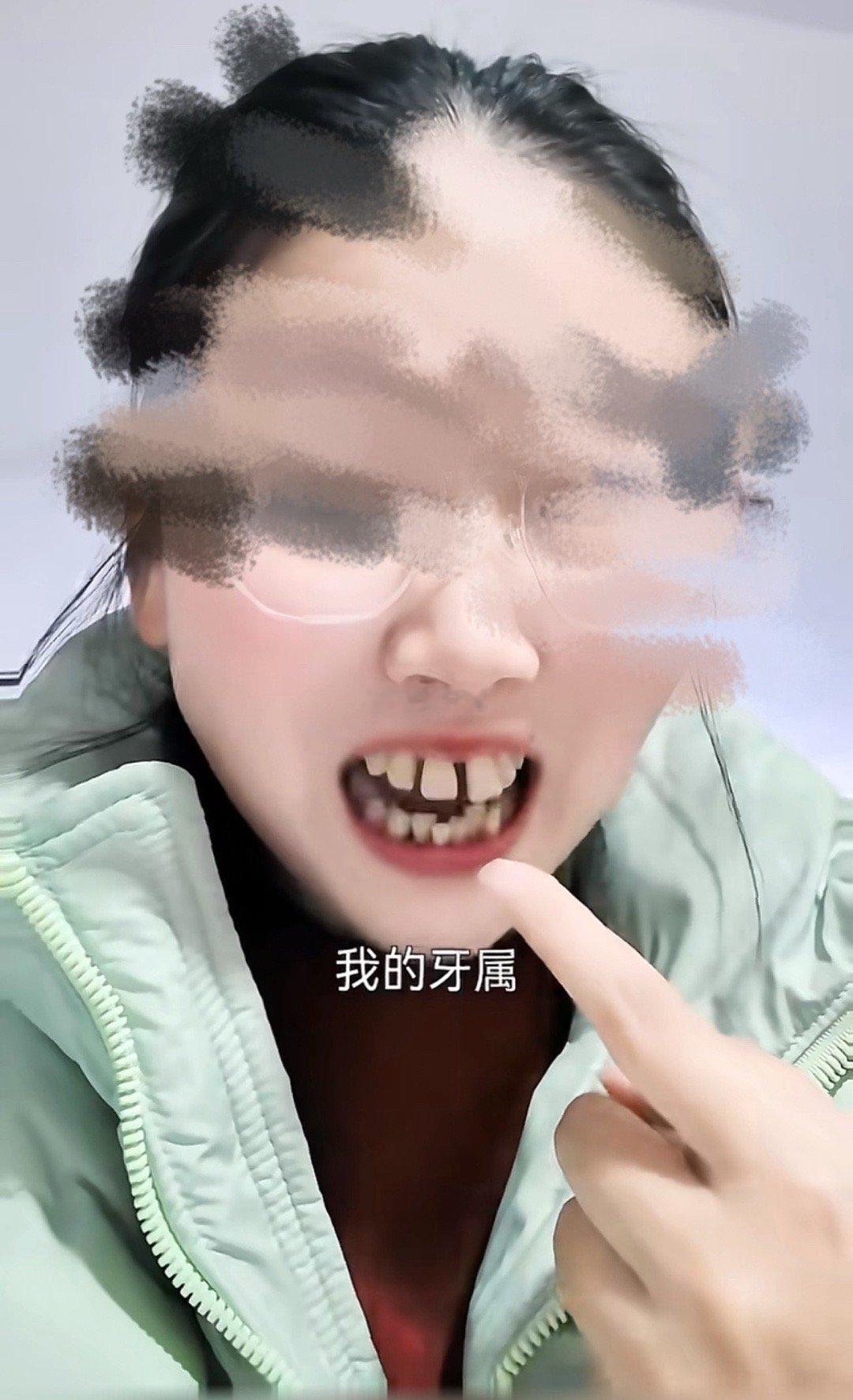 孕前后对比 孕激素导致的重度牙周病 想恢复到以前要花十几万+至少五年时间 已经影