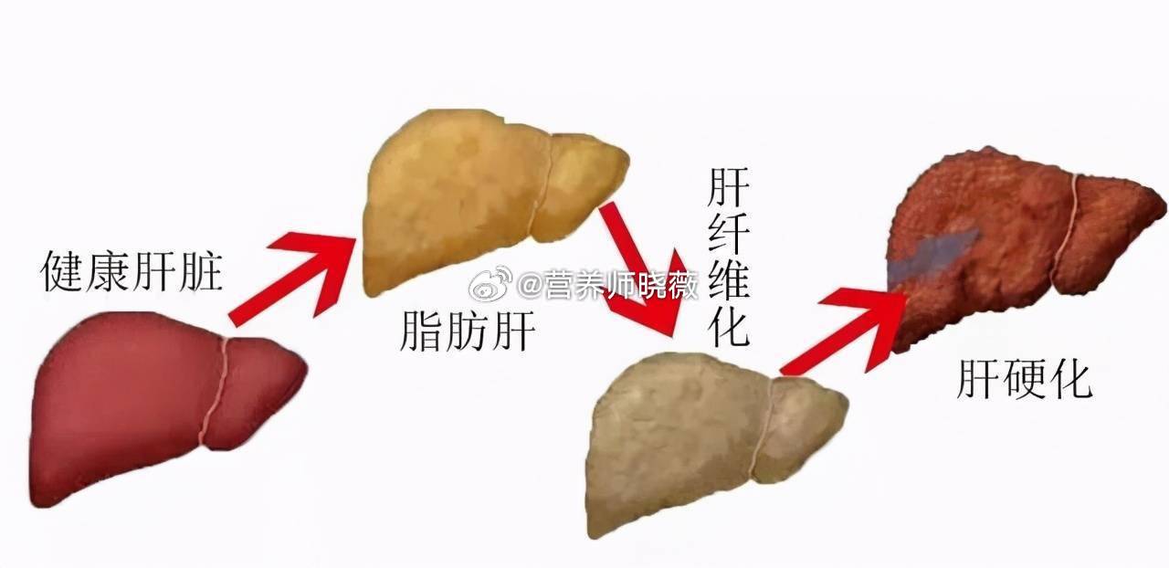 #女生半年减肥40斤查出重度脂肪肝##全民营养提升计划##健闻登顶计划# 肝脏是