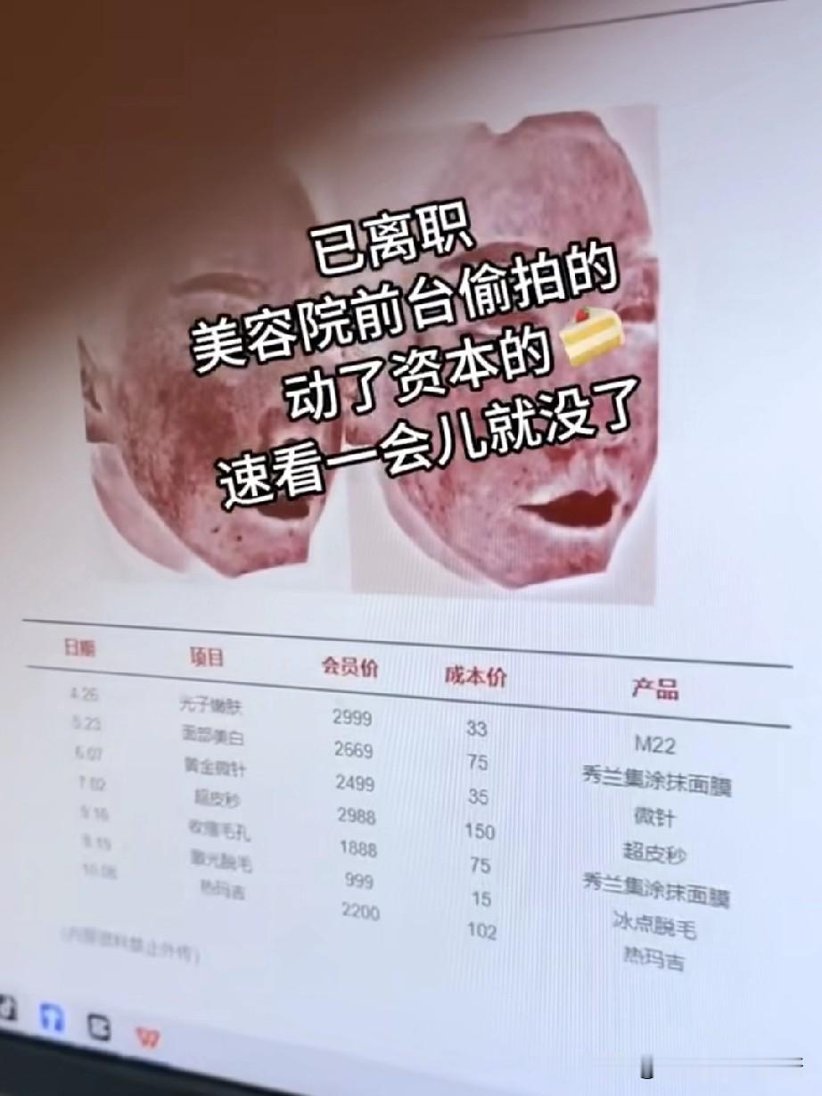 深圳一美容院职员离职前曝行业内幕？会员价2999的光子嫩肤，成本价只要33？这么