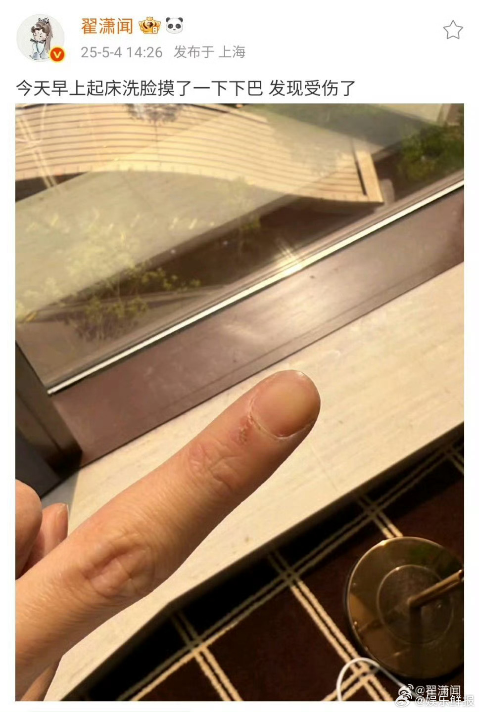 翟潇闻摸了一下下巴受伤了翟潇闻摸了一下下巴受伤了，怎么受的伤？被锋利的下颌线割伤