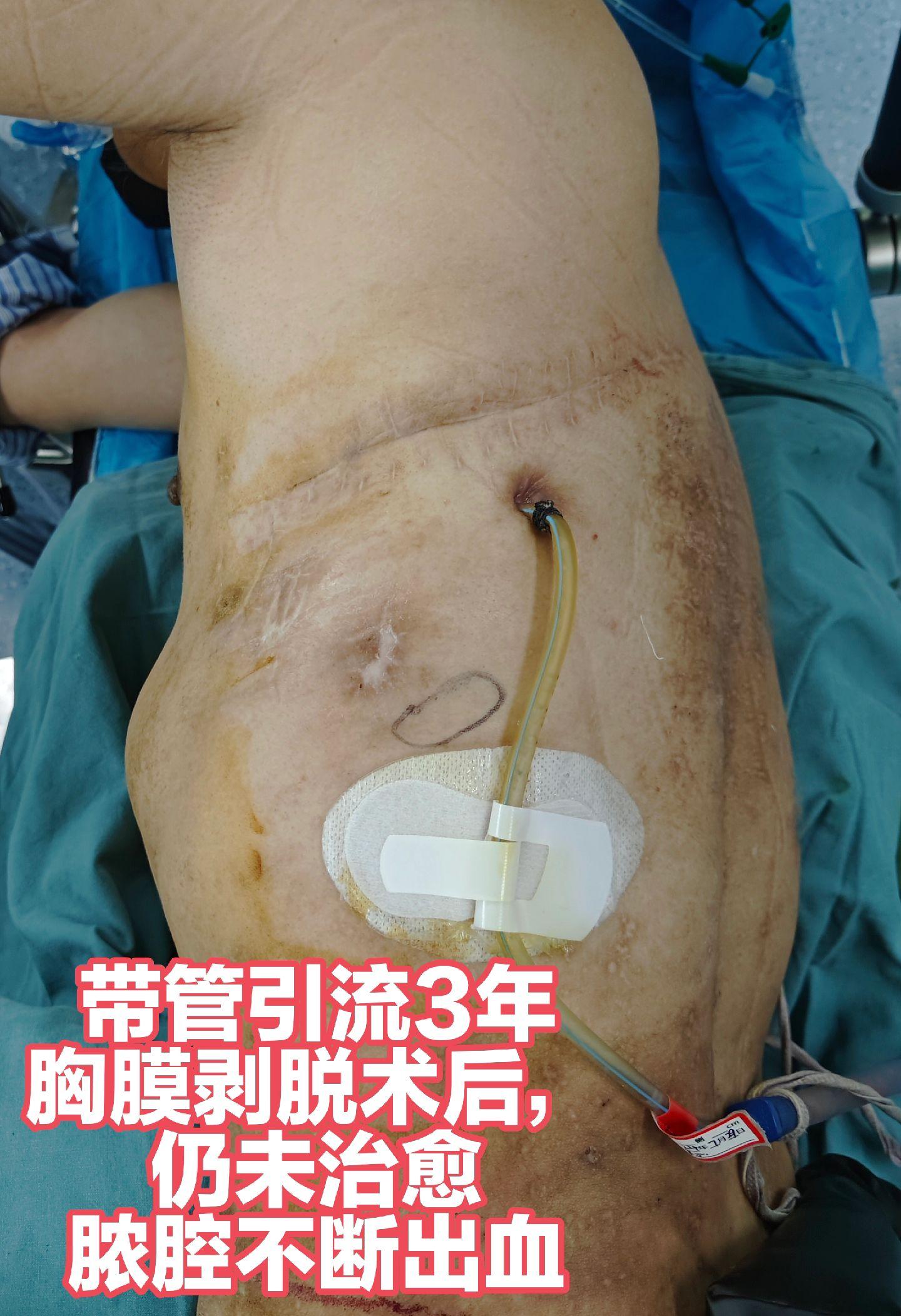 江苏病友，带管3年，胸膜剥脱术后仍未治愈，脓腔不断出血。微创修复，术后...