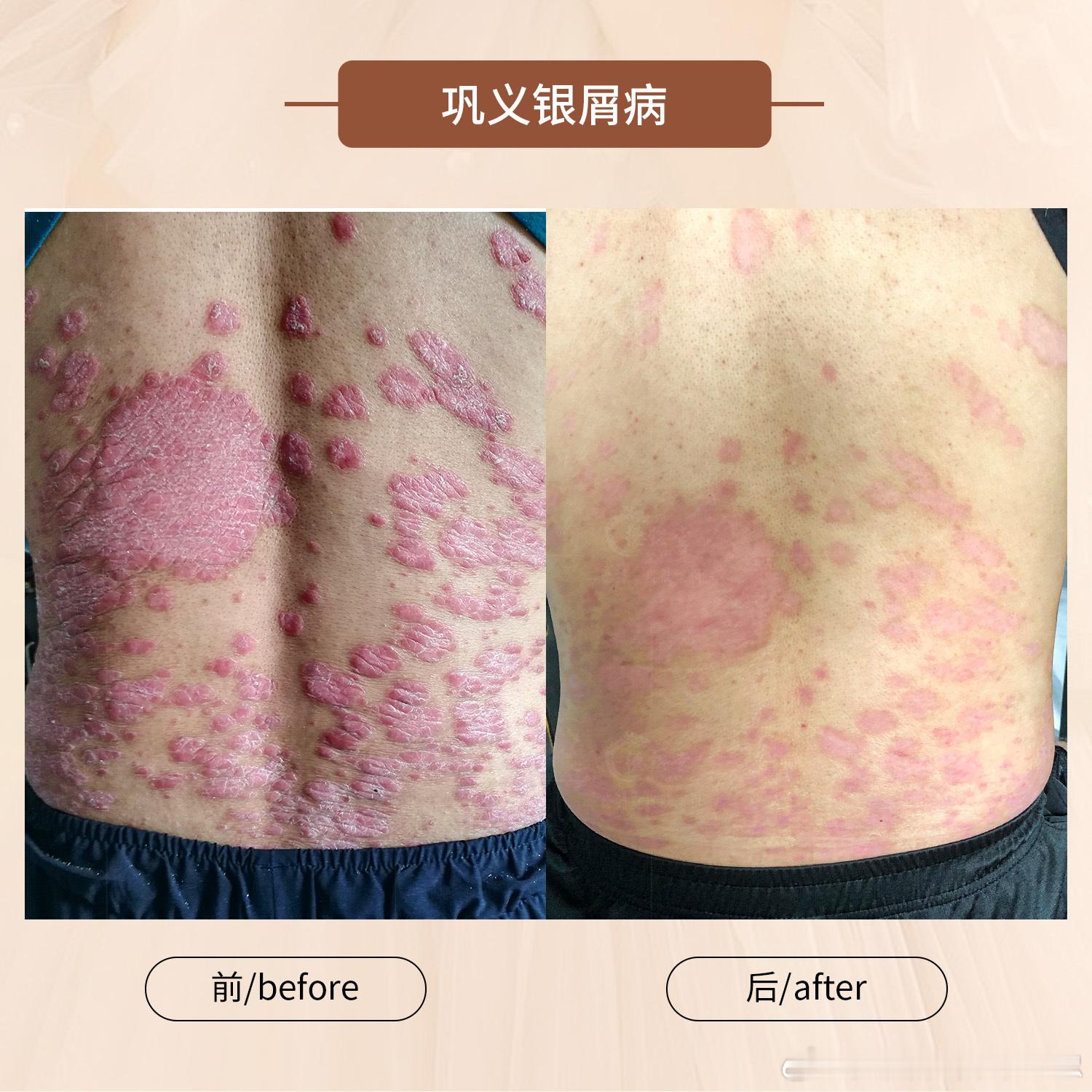 银屑病   牛皮癣[超话]  春季银屑病（牛皮癣）很容易复发，复发的朋友及时用药