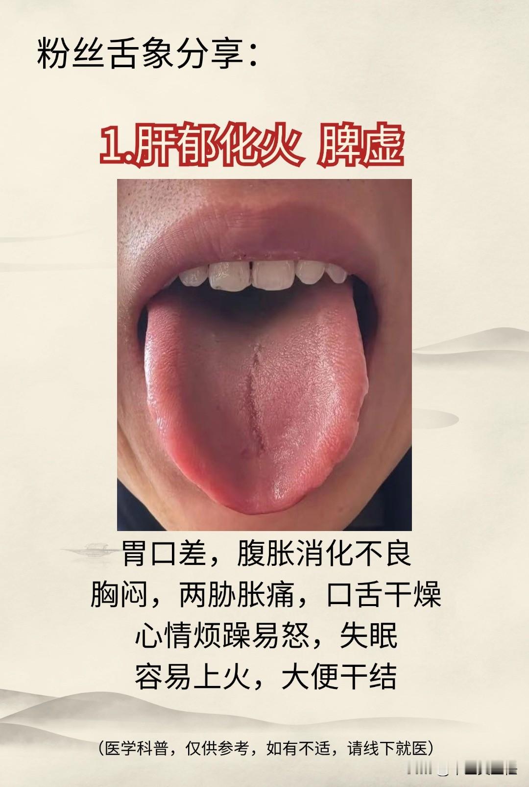 应铁粉要求，每天抽时间分享舌象：
1.肝郁化火 脾虚
2.肝郁 湿热
3.肝郁脾